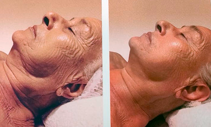 beneficios radiofrecuencia